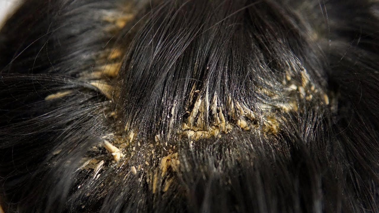 Itchy Psoriasis Scalp Dandruff Flakes Scratching Scratching Huge 