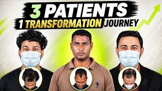 Hair Transplant in Chennai (HX-RDDE) | Best Results & Cost of Hair Transplant in Chennai