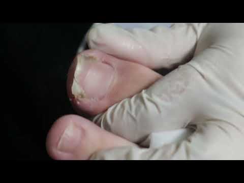 Ep_3656 Toenail removal 👣 เล็บใหม่..มันชนเนื้อใช่ไหมครับ 😷 (clip from Thailand)