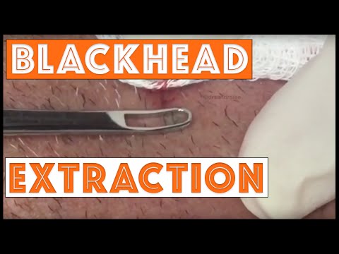 Sometimes a patient has only one blackhead... - Sometimes a patient has only one blackhead...