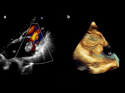 Linksatrialer flottierender Thrombus bei rheumatischer Mitralklappenerkrankung