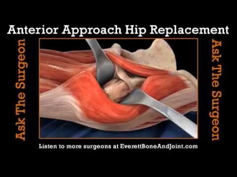 What is an anterior hip replacement?