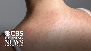 South Carolina Measles Outbreak Explodes To Nearly 800 Cases