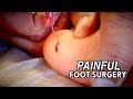 Painful foot surgery we had to operate fast  dr paul