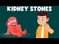 Understanding Kidney Stones