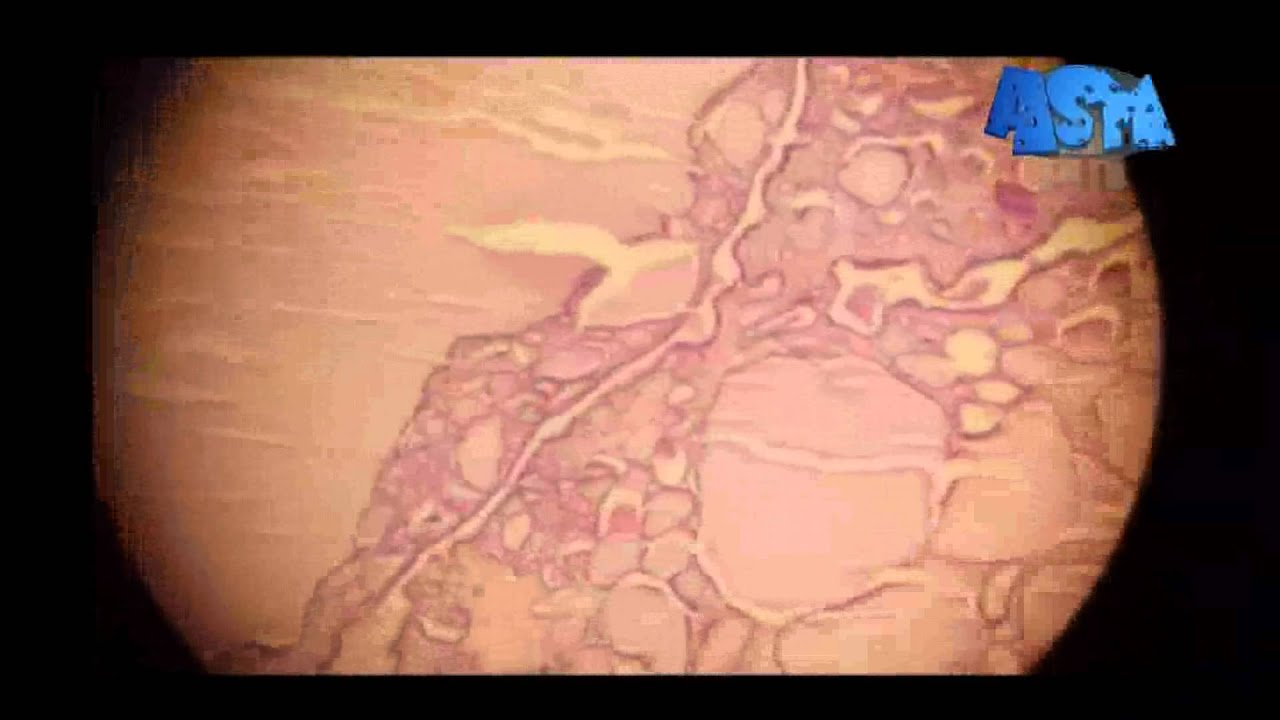 Colloid Nodular Goiter By Asm Youtube