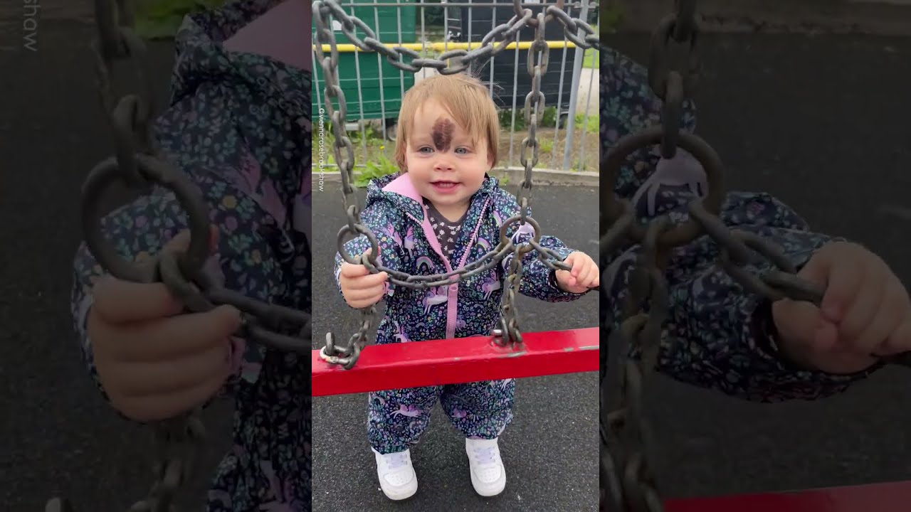 Little Girl Gets Birthmark Removed 