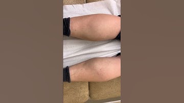 Calf fasciculations, calf twitching , demyelination.