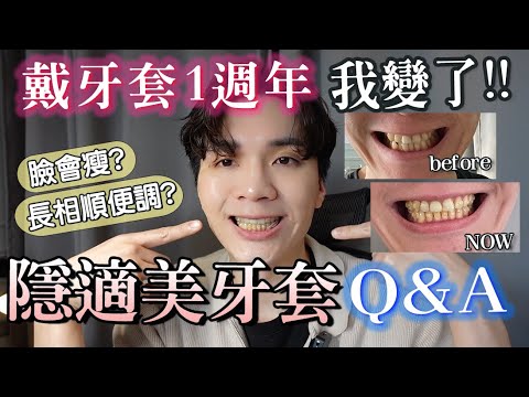 隱適美牙套1年心得！連臉都長不一樣了？回覆網友隱形牙套問題！｜米鹿deerdeer