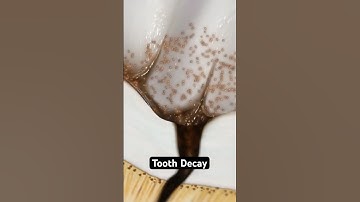 How decay destroys your teeth (3D Animation)