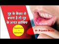 Mouth Cancer क्या होता हैं? | How To Detect Mouth Cancer | Treatment Of Mouth Cancer?  By Dentist