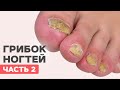 Грибок ногтей на ногах 2 часть | Зачистка Онихомикоза