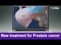 Hifu prostate cancer treatment offers noninvasive alternative