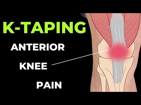 How to apply Kinesiology Taping for Knee Pain - Patella tendonitis and Patella femoral pain