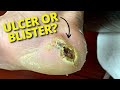 (SUPER SATISFYING!) Different Ways To Care For An Ulcer Or Blister!