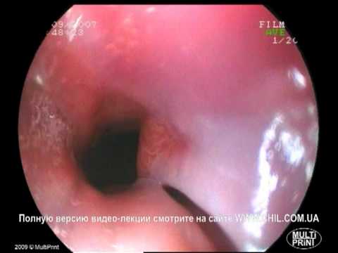 Метаплазия слизистой оболочки пищевода