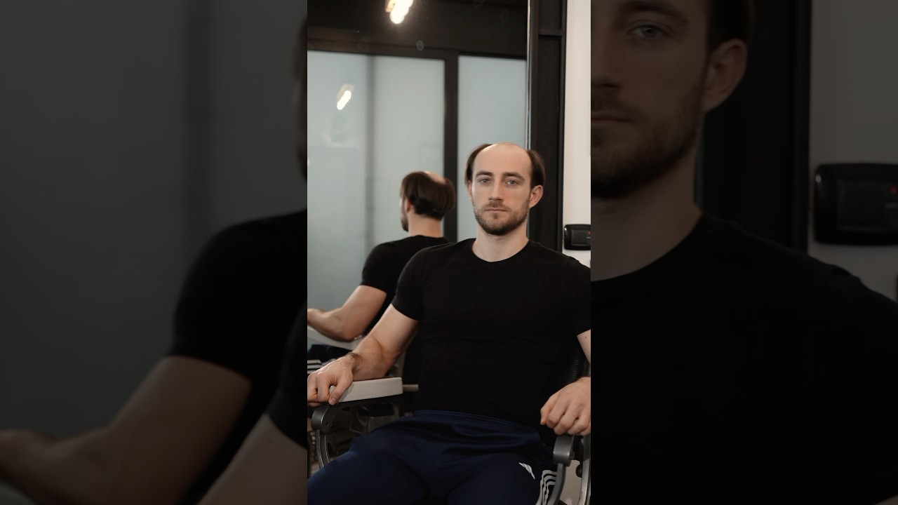 Il Cambiamento di Carmelo con le nostre Protesi Capelli HairAgain 