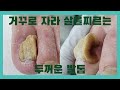 거꾸로 자라 살을 찌르는 무좀발톱 관리하기!