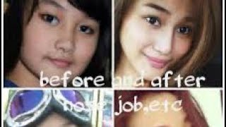 Chienna Filomeno Before And After Plastic Surgery Nagparetoke Ng Ilong