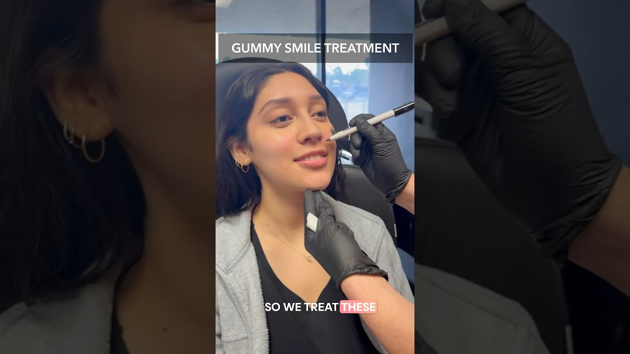 Gummy Smile Treatment 💉