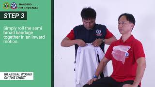 Bilateral Burn on Chest