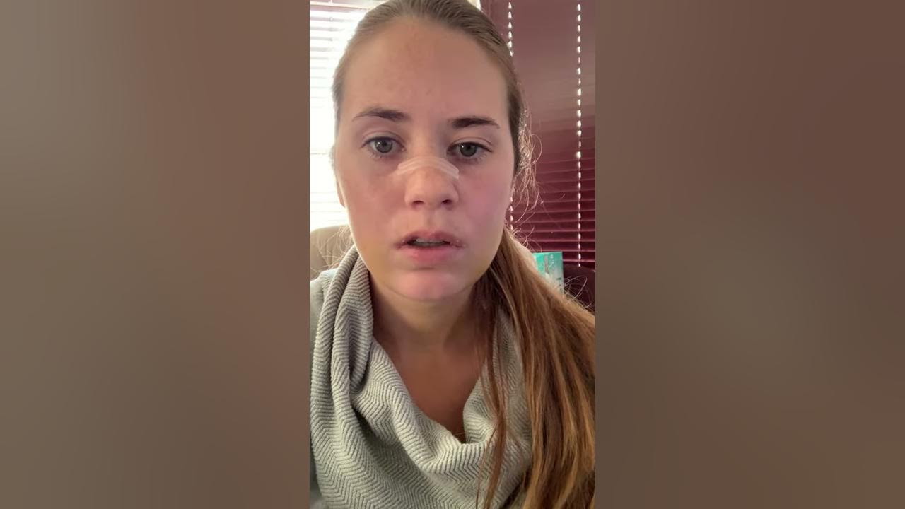 6 Days Post Op Double Jaw Surgery Invisalign YouTube