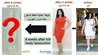 Full body liposuction in Korea 8 weeks before and after - قبل وبعد شهرين من عملية شفط الدهون