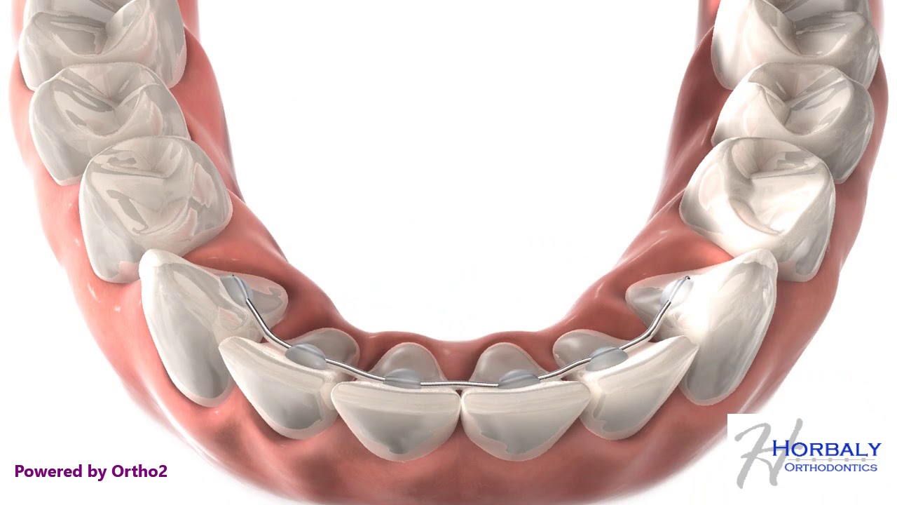 Bonded lower lingual retainer - YouTube