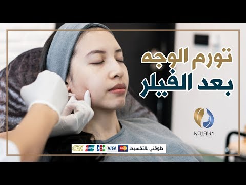 تورم الوجه بعد حقن الفيلر Filler