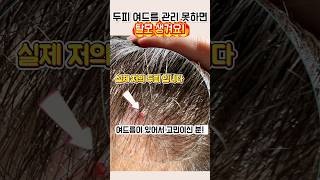 이거 관리 못하면 탈모 생길 수 있습니다!(두피여드름, 모낭염)