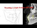 How to trace the Ceph from a CT scan