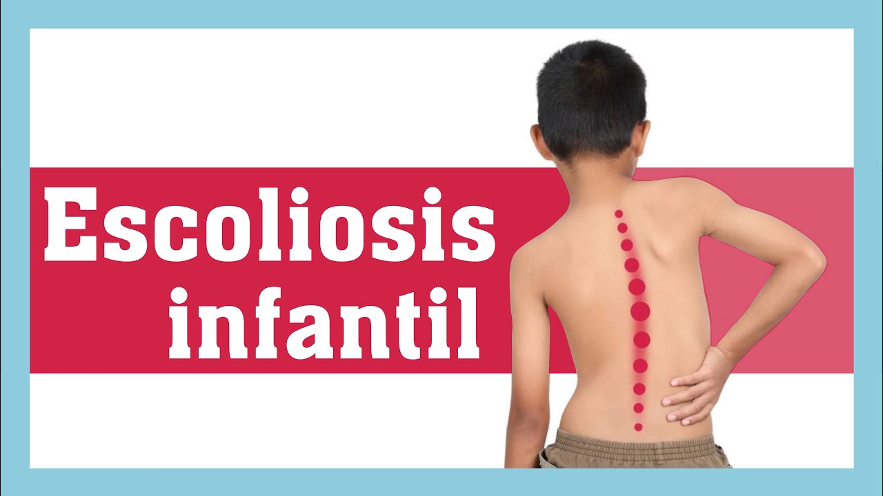 Escoliosis o desviación lateral de columna - Qué es, causas, tipos