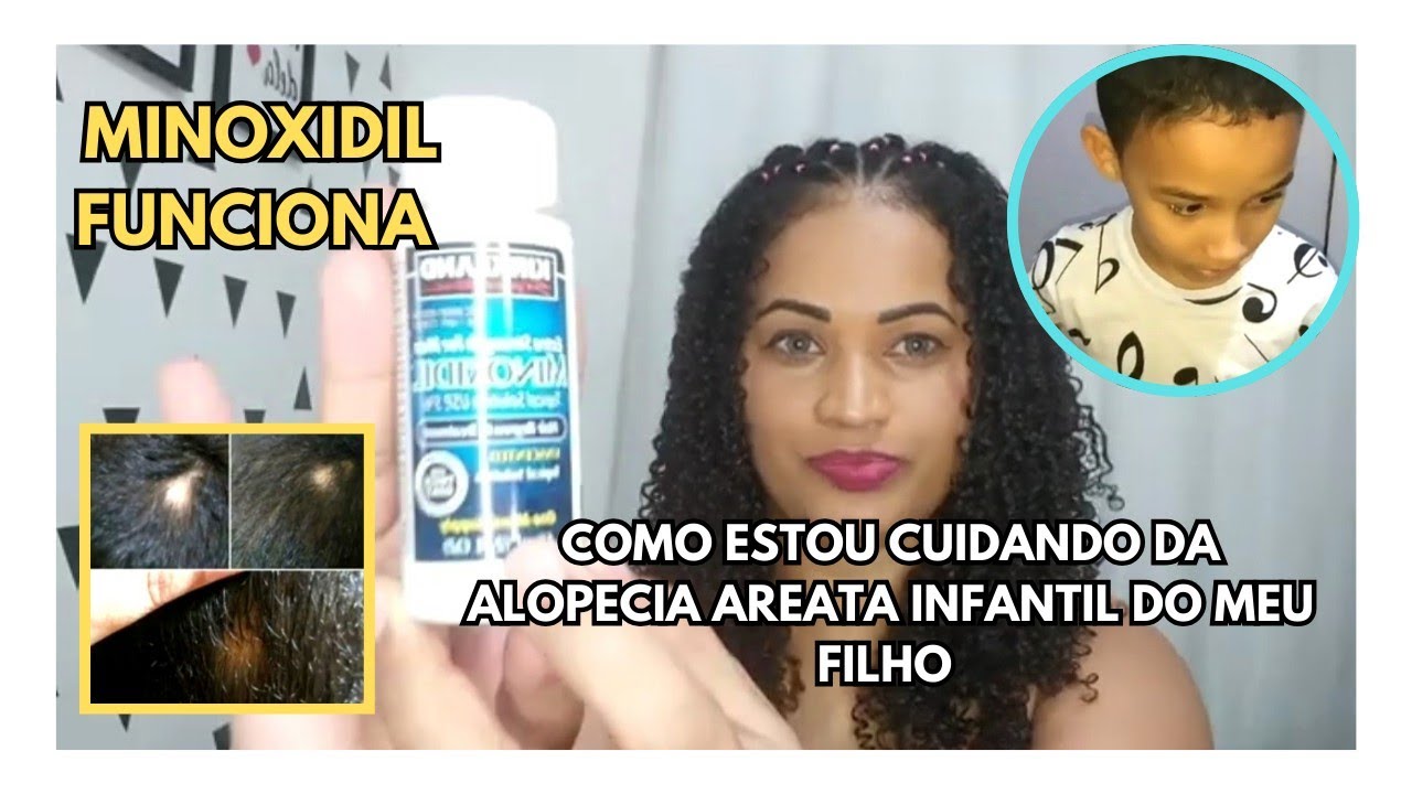 TRATAMENTO PARA ALOPECIA AREATA INFANTIL MINOXIDIL/FUCIONA CRESCE MUITO ...