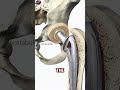 The Secret Inside Your Hip: How Modern Implants Move 🦴
