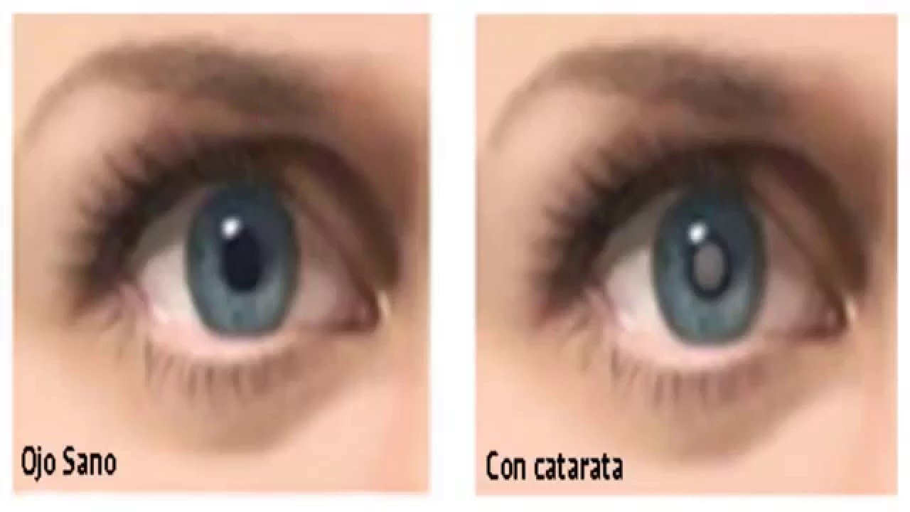 Remedios para las cataratas