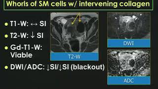 MRI of Benign Uterine Conditions-- Susan Ascher, MD (SCBT-MR/SABI 37th Annual Course)