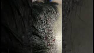 زراعة الشعر وتصغير الجبهة للسيدات في مركز بيلادونا كلينك