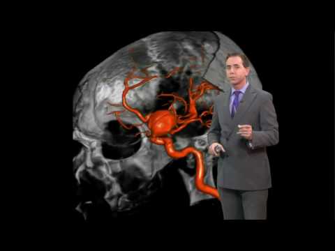 Real Men Wear Gowns: Detecting aneurysms early