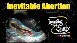 Inevitable Abortion || Ultrasound || Case 208