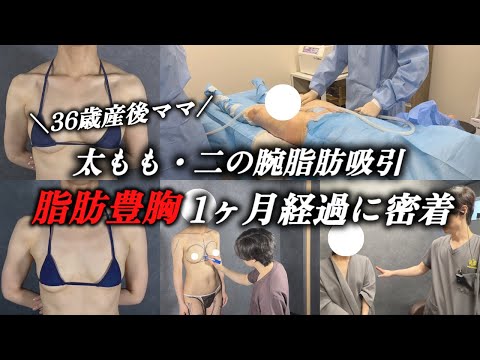 【脂肪豊胸のダウンタイムのリアル】３６歳産後ママの太もも・二の腕脂肪吸引から脂肪豊胸！マーキングから施術、ダウンタイム経過、ビフォーアフターを大公開