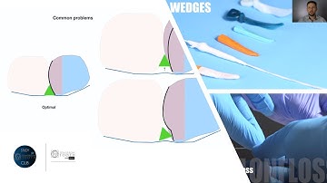 Preview Wedging and Teflon Floss Technique.  How can I manage it?