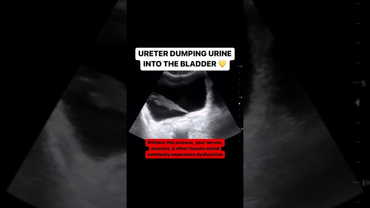 Ureter Jetting Urine Into The Bladder