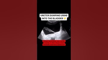 Ureter jetting urine into the bladder