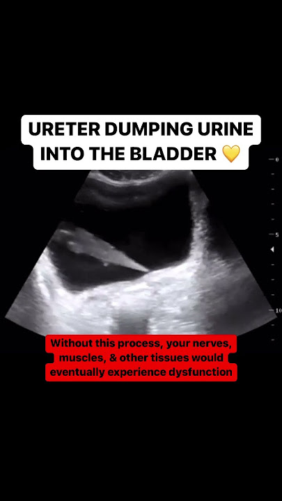 Ureter jetting urine into the bladder