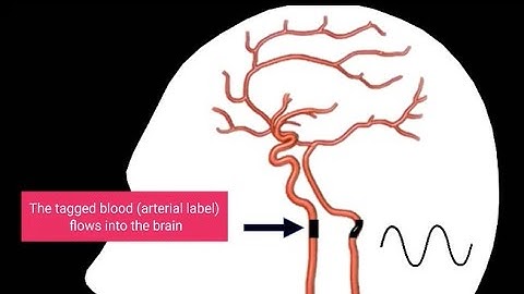 Arterial Spin Labeling MRI