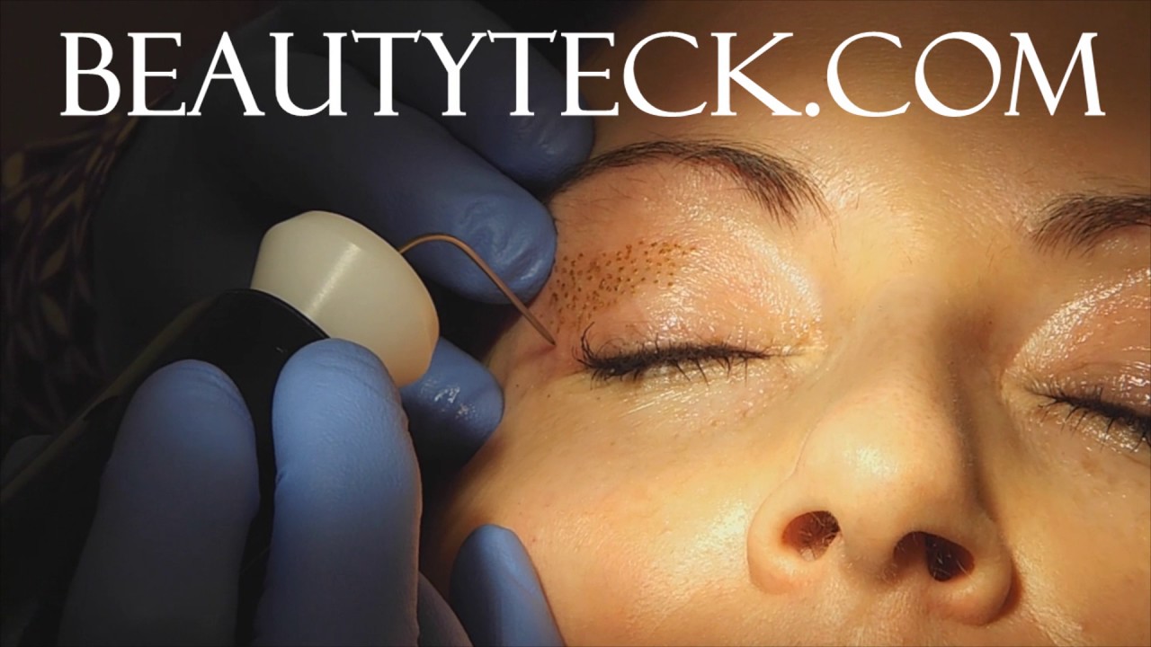 Upper Eyelid Tightening Using Plasma Medium Intensity Treatments