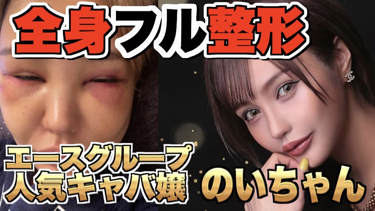 【エースグループのいちゃん】総額３８０万円相当の全身整形！！ダウンタイム中〜術後インタビューまでのリアル【SBC外科統括院長 横谷Dr執刀】