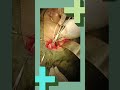 CBD stone | choledocholithotomy / #surgeon #jamui #laparoscopicsurgeon #educationalvideo