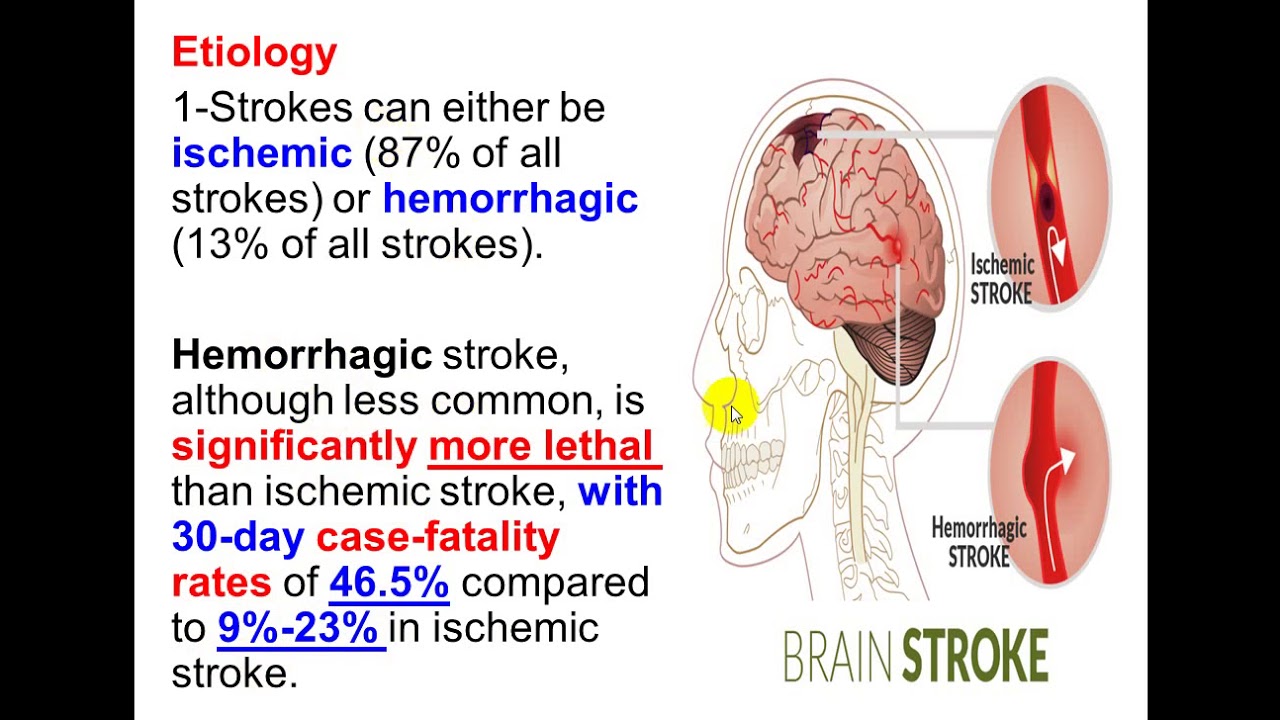 Stroke. By Dr. Dheyaa Jabbar
