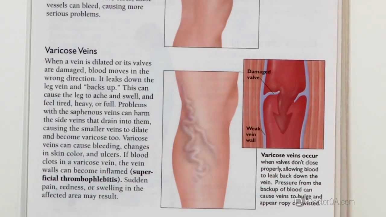 Can losing weight help remove varicose veins? Dr. William Bowers, MD YouTube